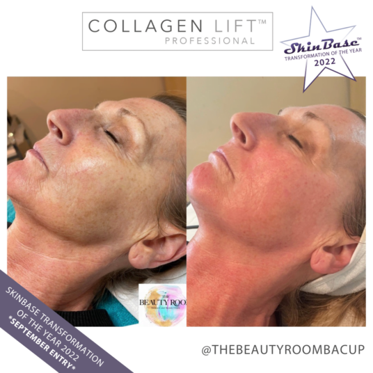 The Beauty Room Collagen Lift Before and After The Beauty Room Collagen Lift Before and After