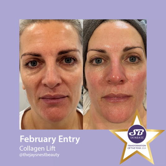 February Collagen Lift transformations the jays nest February Collagen Lift transformations the jays nest