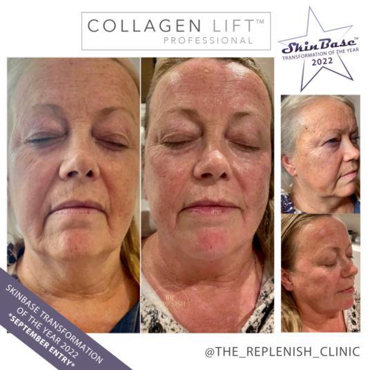 The Replenish Clinic Collagen Lift Before and After The Replenish Clinic Collagen Lift Before and After