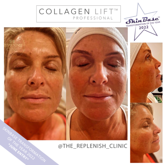 Must See Collagen Lift Transformation Must See Collagen Lift Transformation