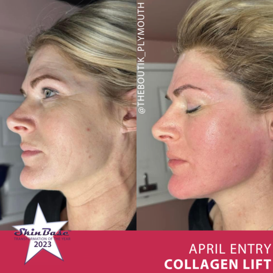 April transformation entries April transformation entries collagen lift facial sculpting