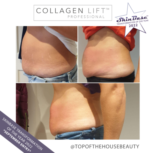 post-pregnancy skin concerns