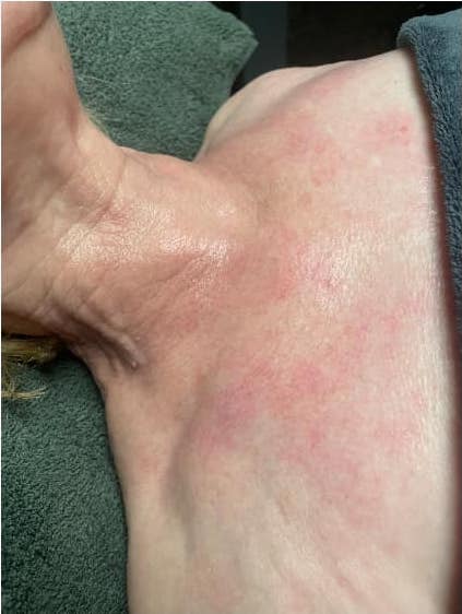 before and after collagen lift 2 beauty spot sc 2