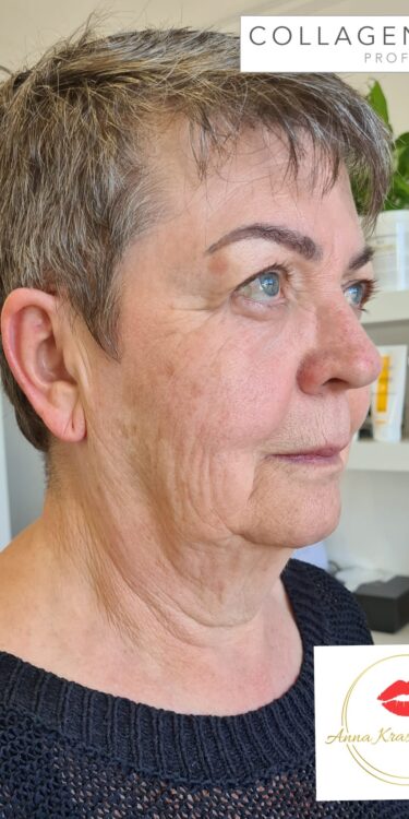before and after collagen lift anna krason beauty 1
