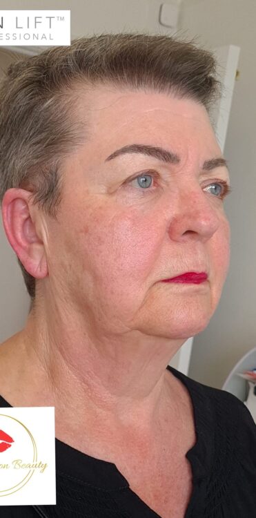 before and after collagen lift anna krason beauty 2