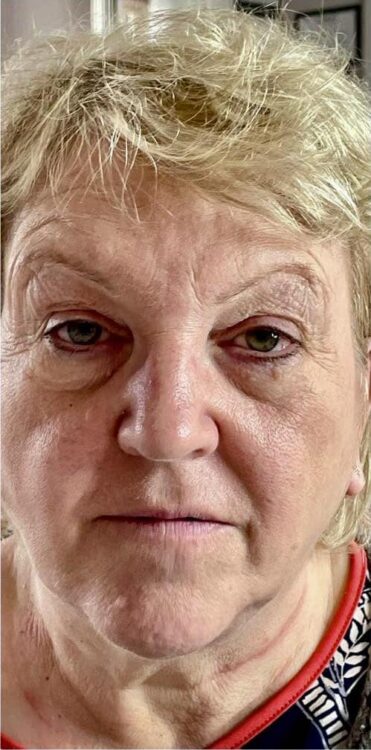 before and after collagen lift bijou beauty room 1
