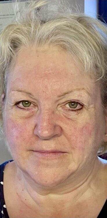 before and after collagen lift bijou beauty room 2