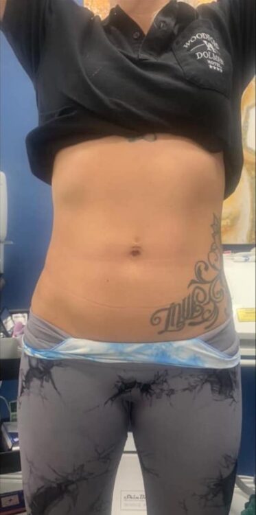 before and after collagen lift cc clinic 1