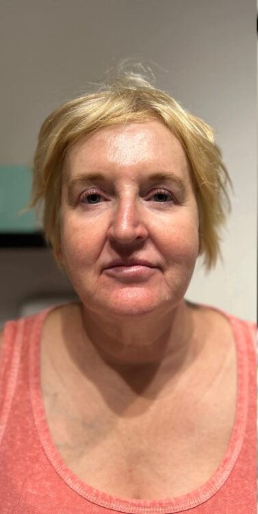 before and after collagen lift fake it hair nails 1
