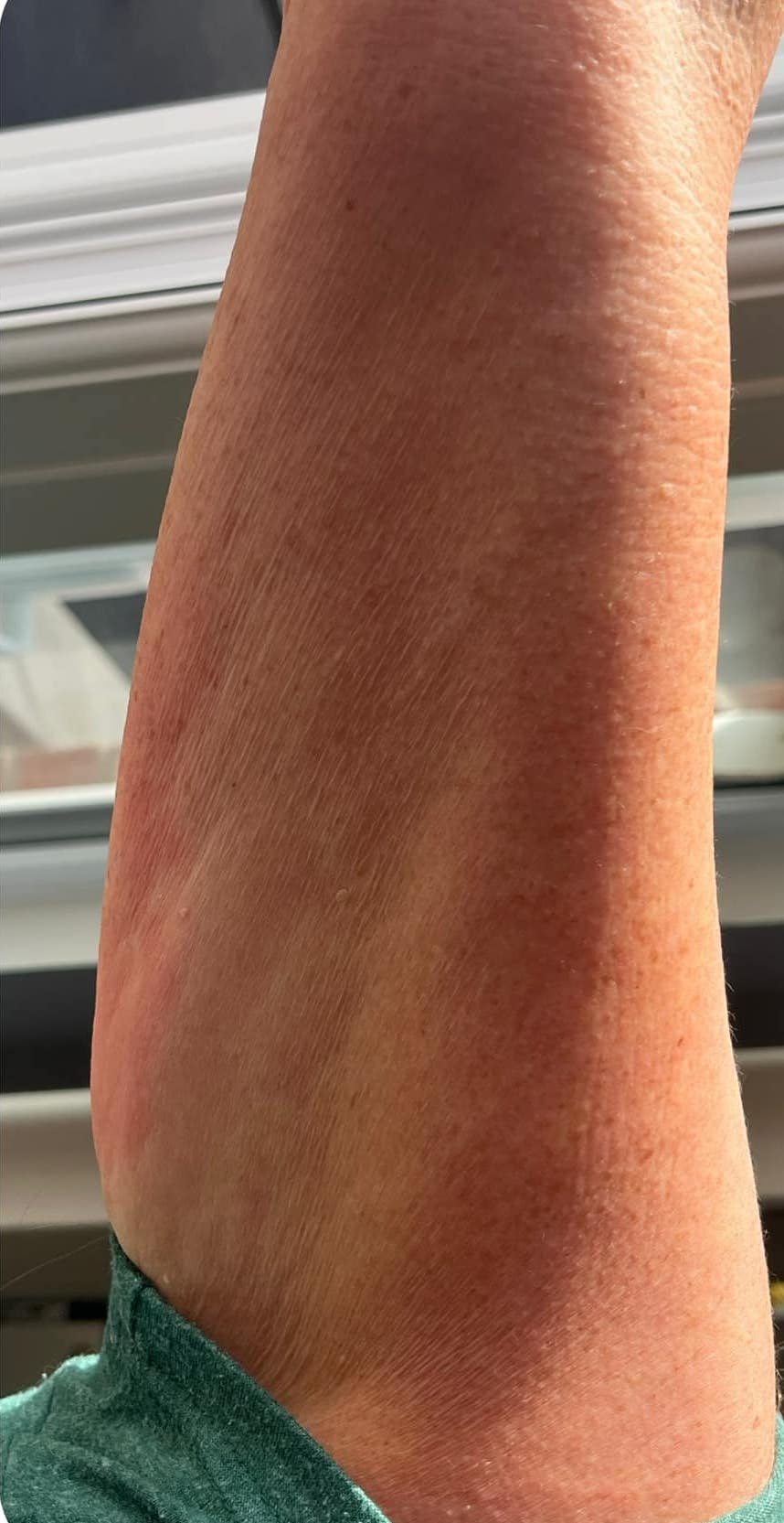 before and after collagen lift holmes aesthetics 1