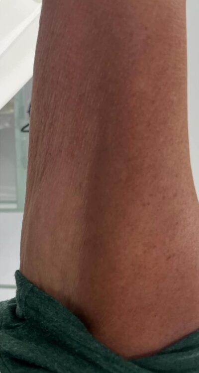 before and after collagen lift holmes aesthetics 2
