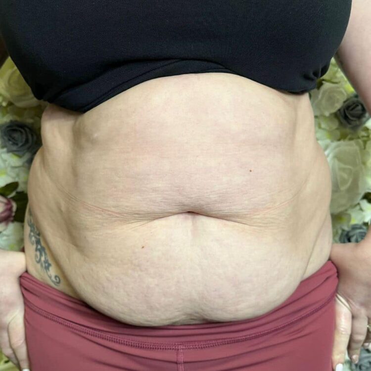 before and after collagen lift lauren e summers 1