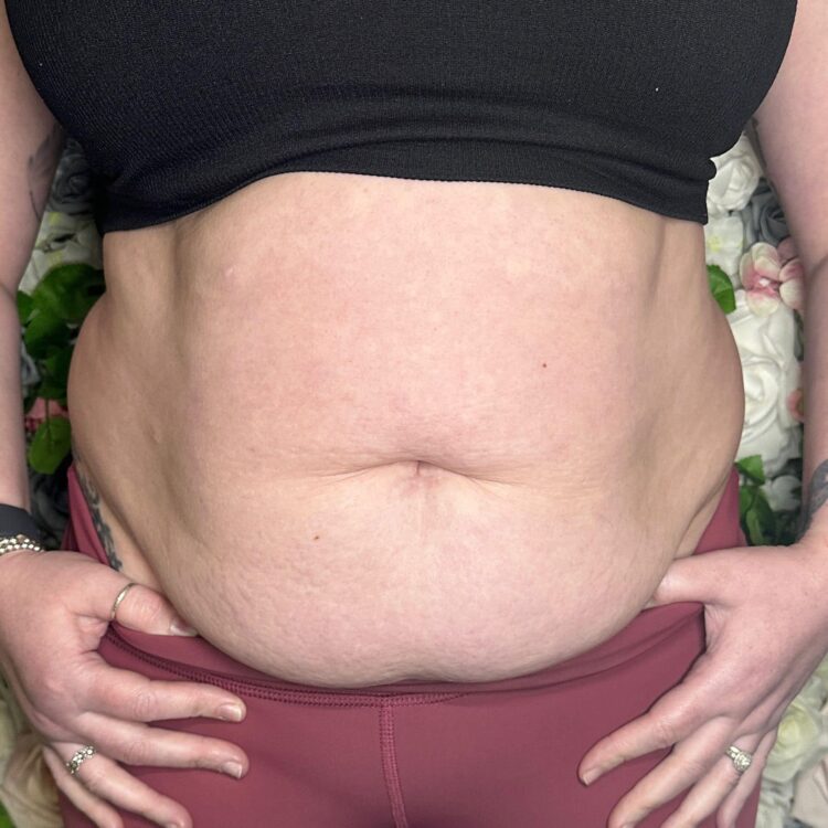 before and after collagen lift lauren e summers 2