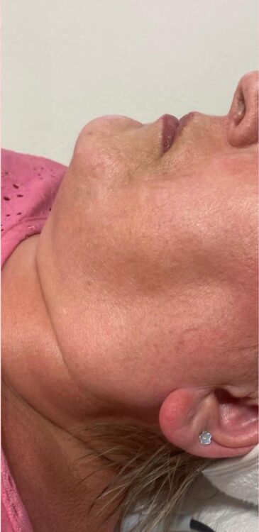 before and after collagen lift microdermabrasion natural beauty by natalie 1