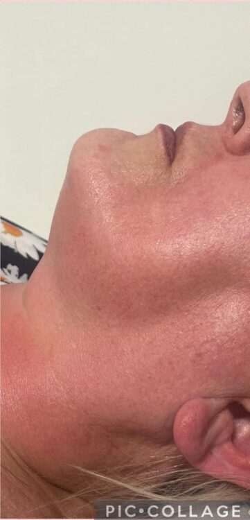before and after collagen lift microdermabrasion natural beauty by natalie 2