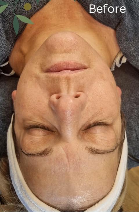 before and after collagen lift serenis beauty 1