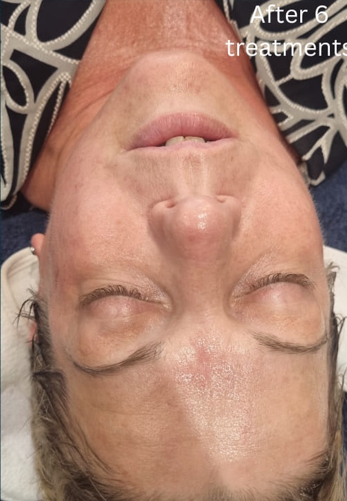 before and after collagen lift serenis beauty 2