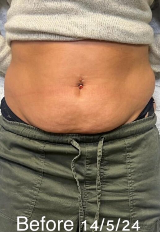 before and after collagen lift the beauty lounge 1