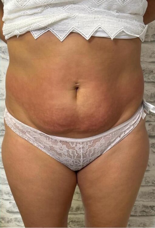 before and after collagen lift the beauty lounge 2
