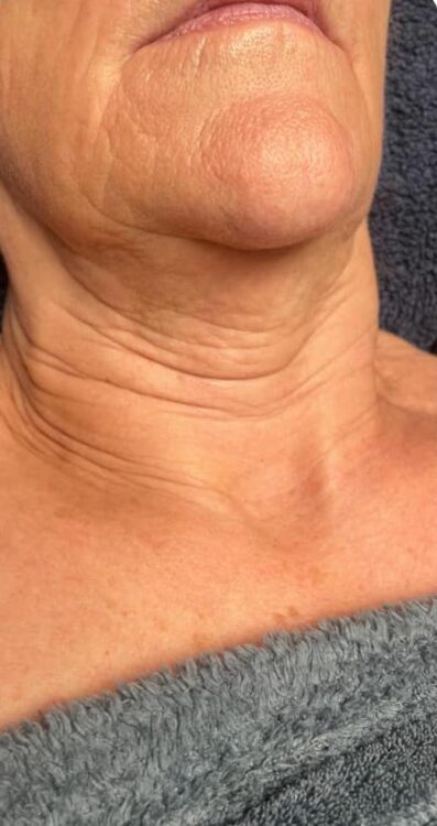before and after collagen lift the beauty spot sc 1