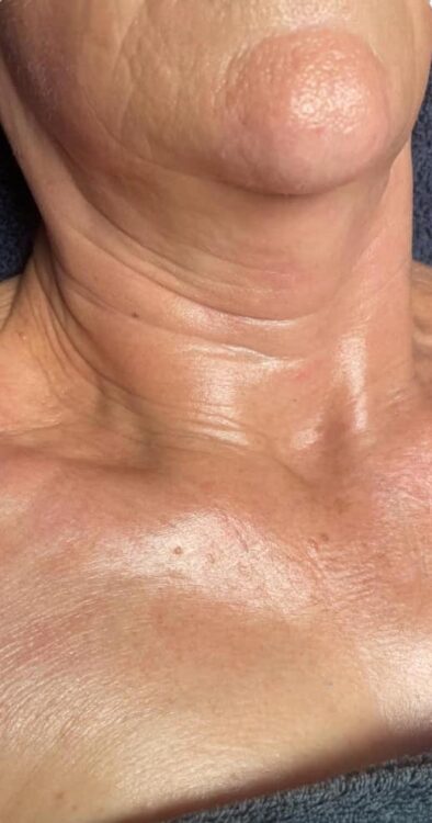 before and after collagen lift the beauty spot sc 2