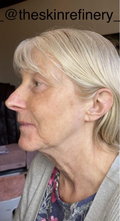 before and after collagen lift the skin refinery 1