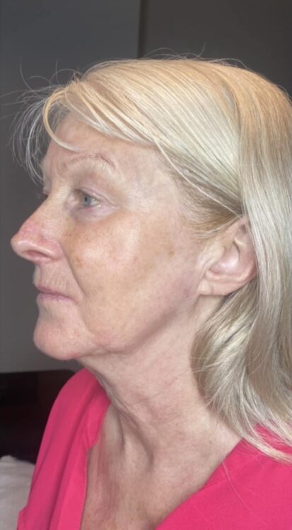 before and after collagen lift the skin refinery 2