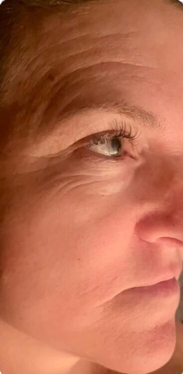 before and after collagen lift ultimate the beauty spot sc 1