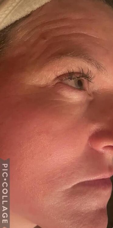 before and after collagen lift ultimate the beauty spot sc 2