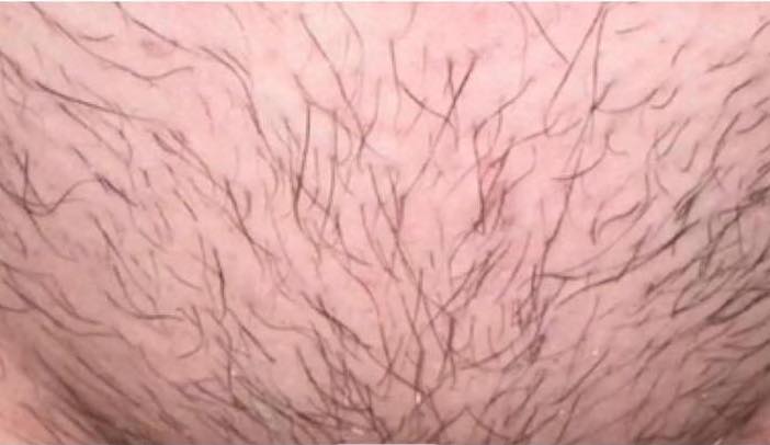 before and after ipl hair reduction naked beauty 1