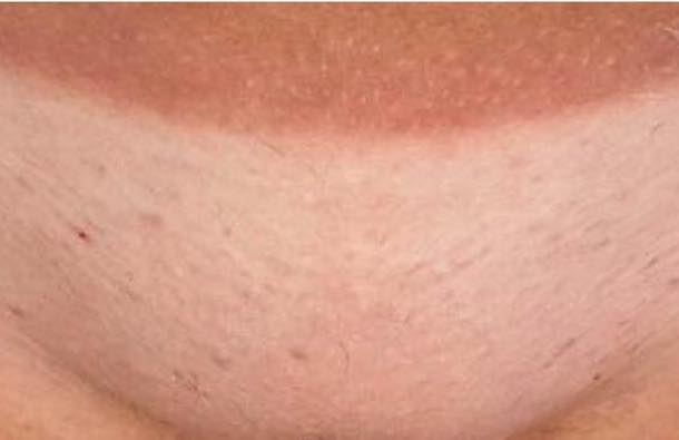 before and after ipl hair reduction naked beauty 2