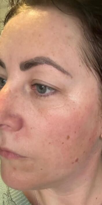 before and after microdermabrasion DB skin therapy 1