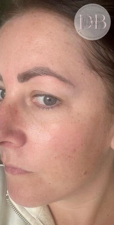 before and after microdermabrasion DB skin therapy 2