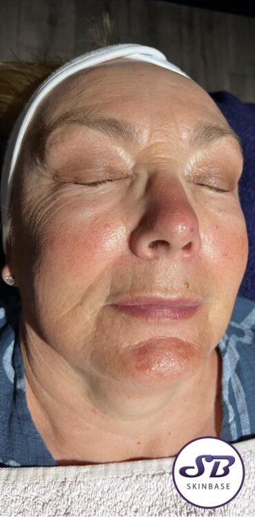 before and after microdermabrasion bethel therapies 1