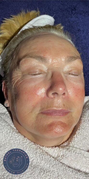 before and after microdermabrasion bethel therapies 2