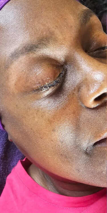 before and after microdermabrasion kays sanctuary 1