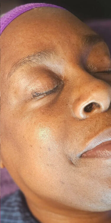 before and after microdermabrasion kays sanctuary 2