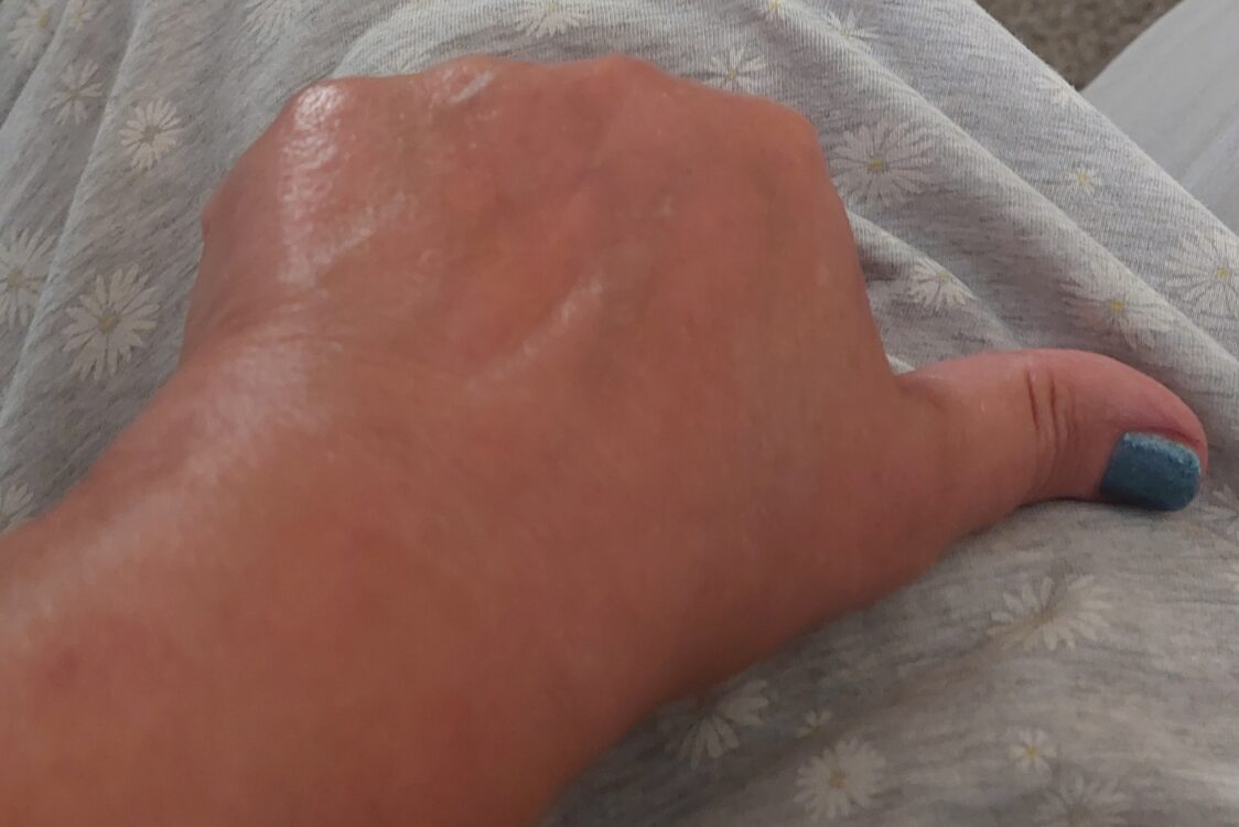 before and after microdermabrasion natures holistics 2