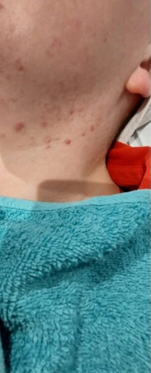 before and after microdermabrasion perfectly pampered by kerry 1