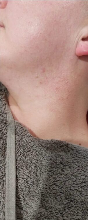 before and after microdermabrasion perfectly pampered by kerry