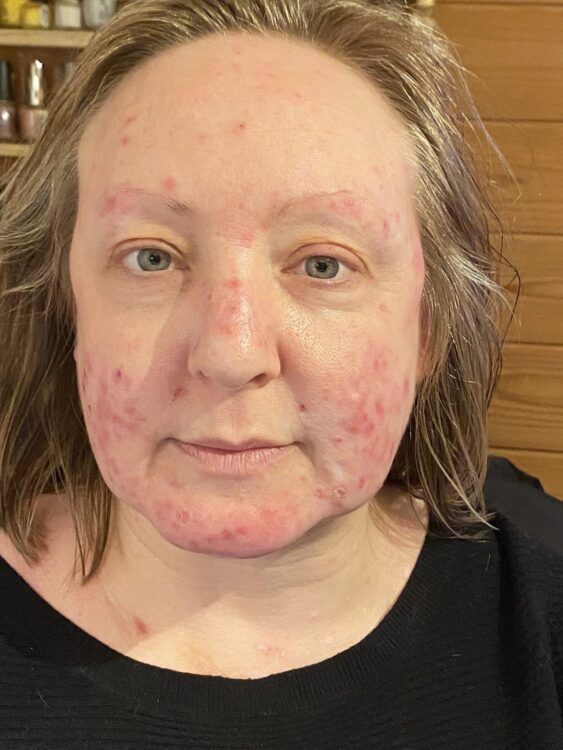 before and after microdermabrasion rachel's beauty retreat 1