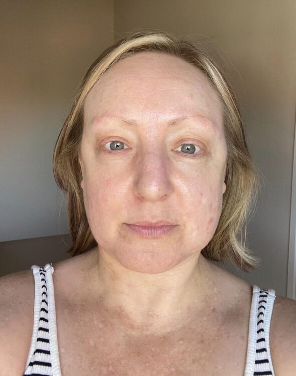 before and after microdermabrasion rachel's beauty retreat 2