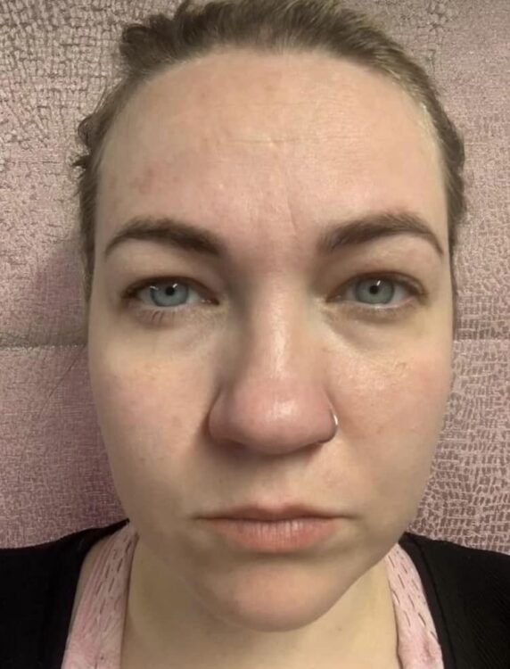 before and after microdermabrasion twinkle with glamour 1