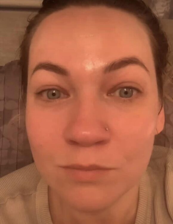 before and after microdermabrasion twinkle with glamour 2