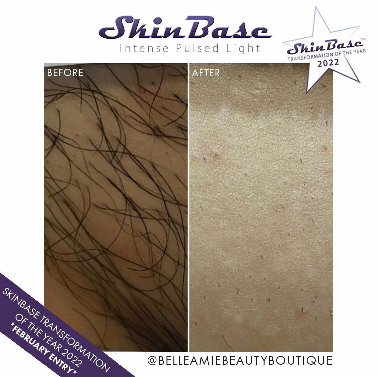 IPL Permanent Hair Reduction