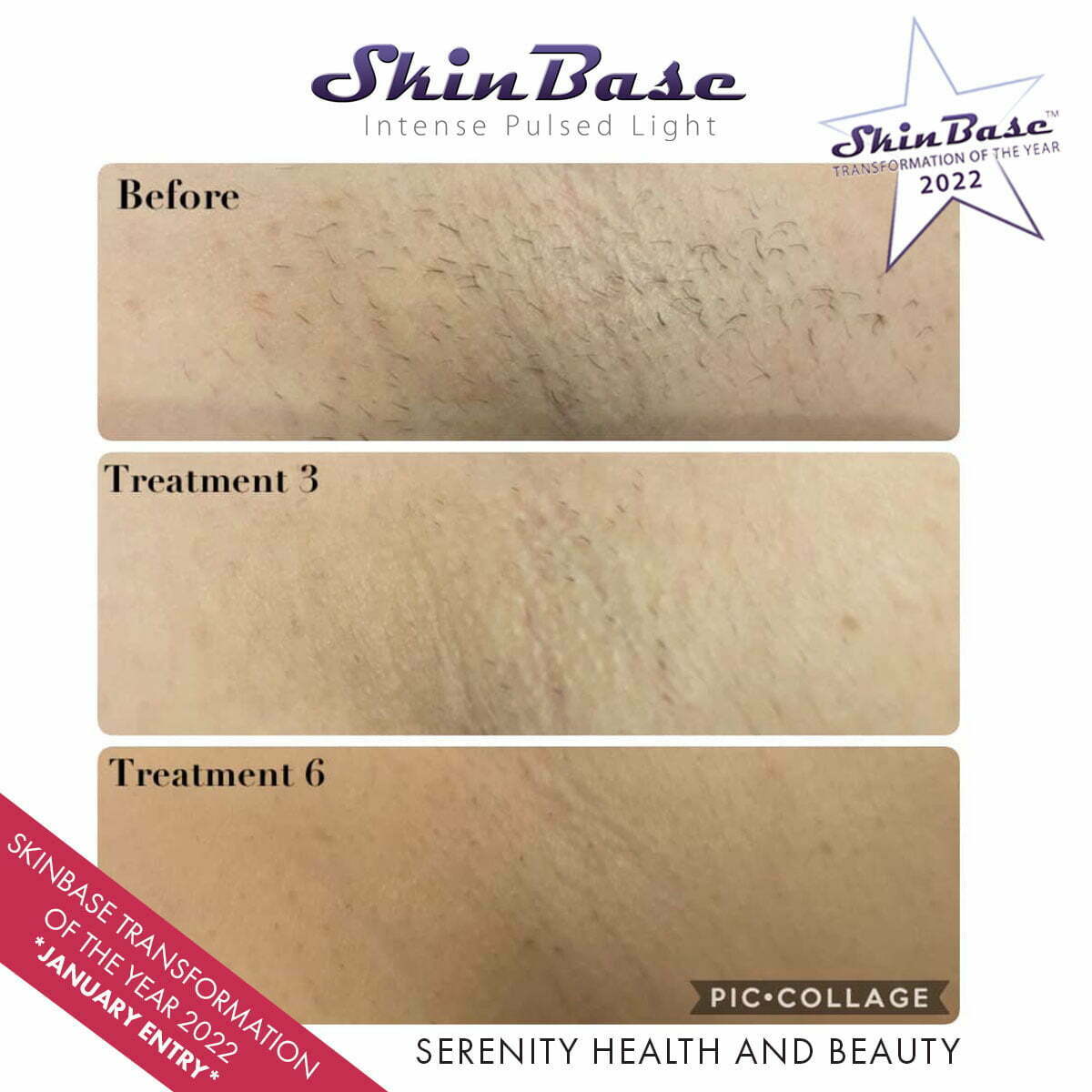 IPL Permanent Hair Reduction