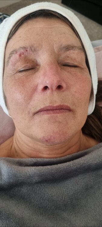 before and after skinbase hydro massage 2 U UK