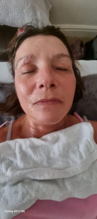 before and after skinbase hydro massage 2 U UK