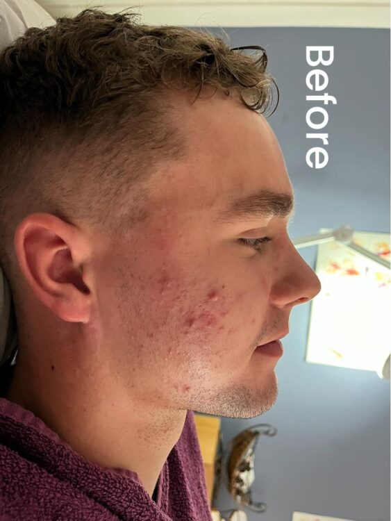 before and after skinbase hydro namrata wellness studio