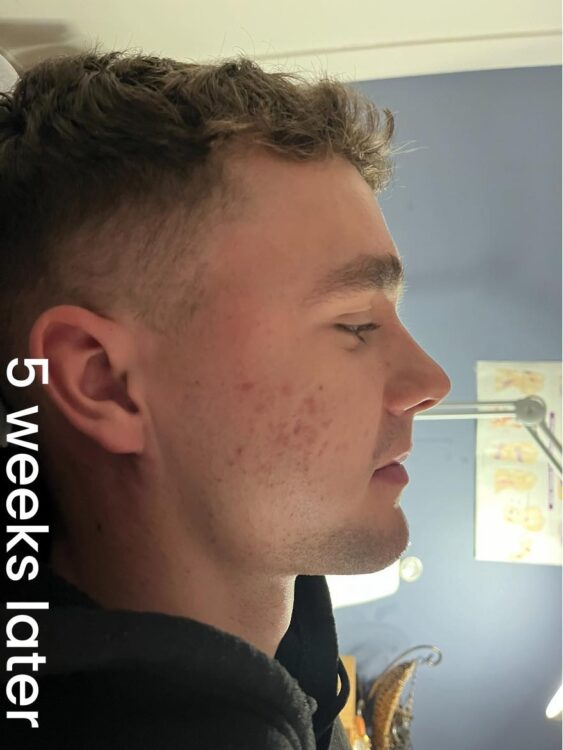 before and after skinbase hydro namrata wellness studio